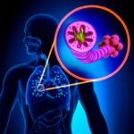 ACUTE EXACERBATIONS OF CHRONIC BRONCHITIS