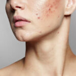 Make Acne Worse